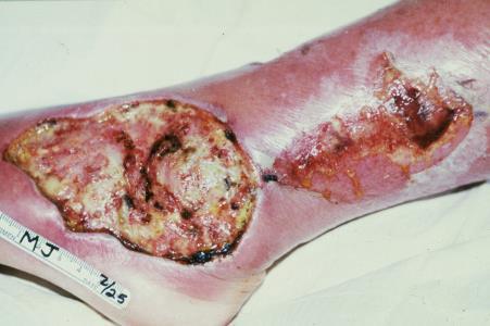 WWC? MODULE #1 CHRONIC WOUNDS Etiology