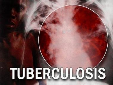 County TB public health