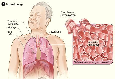 COPD Diagram of the lungs and airways with an inset showing a detailed crosssection of normal