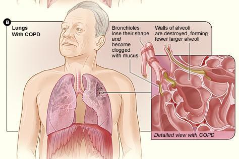 Damaged by COPD with an inset showing a crosssection of damaged  http://1.bp.blogspot.