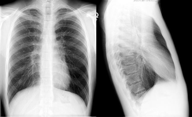 Hyperinflation Hyperinflation of lungs occur in asthma, emphysema and chronic bronchitis. Findings of hyperinflation are: Dark lung fields. Low set diaphragm in 11th or 12th posterior rib.