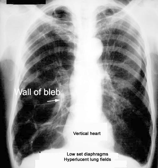What are the x-ray findings of emphysema? Lungs are large and hyper inflated. Signs of hyperinflation are: Low set diaphragm. Flat diaphragm best determined by lateral chest. Hyper lucent lung fields.