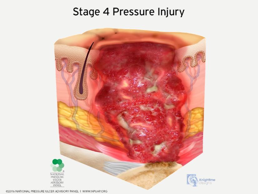 10/30/2017 S TA G E 4 PRESSURE ULCER: Full-thickness skin and tissue loss Full-thickness skin and tissue loss with exposed or directly palpable fascia, muscle, tendon, ligament, cartilage or bone in