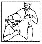 circulation Angulation with absent distal pulse and/or cyanosis Treatment Apply sling/triangular bandage Swathe if additional immobilization is indicated Apply