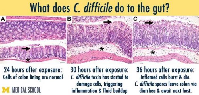 C. diff Infection (CDI) C.