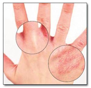What is hand dermatitis?