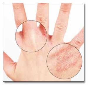 What is hand dermatitis?