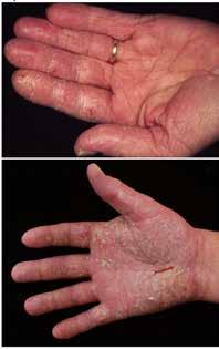 Checking for dermatitis - What to look for What to look
