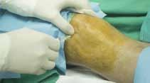 Diabetic Limb Salvage/ Critical Limb and Woundcare: A Team Approach 2015 You Don t Want to Miss This Activity The increasing incidence of diabetic foot ulcers and wounds creates challenges for