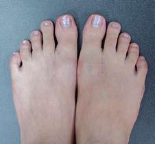 surgery can not only correct bunion deformity but also significantly and consistently improve the all important mechanical functions of patients feet.