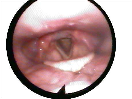NORMAL SWALLOW: Airway is