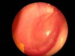 002 asom w/o rupture L ear H66.003 asom w/o rupture bilat H66.004 asom w/o rupture recurrent R Etc. Etc. Etc. Want more?? ICD 9 382.9 unspecified otitis media H66.