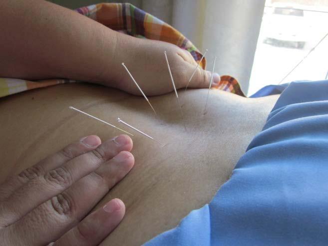 Acupuncture for low back pain. Acupuncture with 9mV In the department of pediatrics, I was placed in the inpatient service.