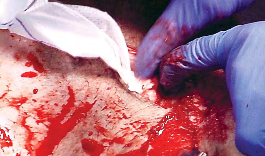 In line with the new external hemorrhage control protocol, effective wound packing should be added to the standard prehospital and first responder skill set.