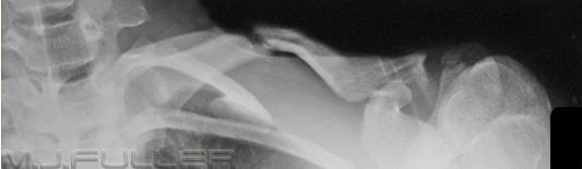 There is no displaced clavicle fracture seen.