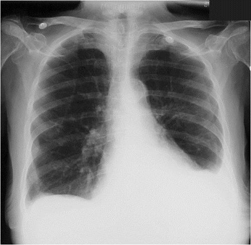 Artifacts Artifacts can both obscure pathology and mimic pathology Case 6 This patient has what appears to be a left pneumothorax.