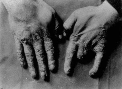 Controversies and Problems Mystery Burns, Radium, and Conspiracy X-Ray technicians fell victim to the horrible side-effects