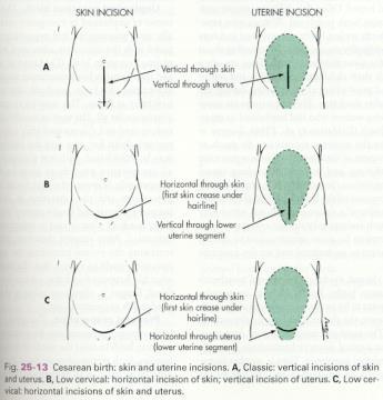 supine position Skin incision: Vertical Low transverse Uterine