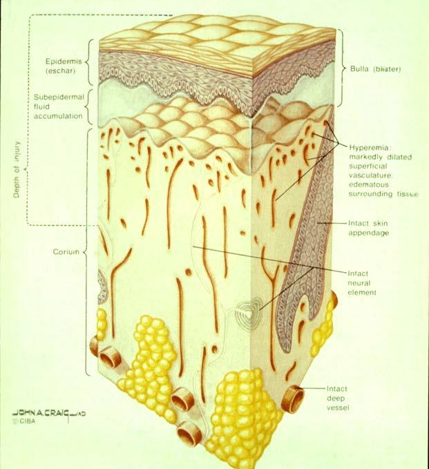 Epidermal ( first degree ) Partial-thickness (