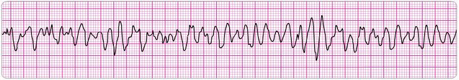 Bradycardia j) Atrial Flutter k) Atrial Fibrillation l) Coarse Ventricular Fibrillation m)