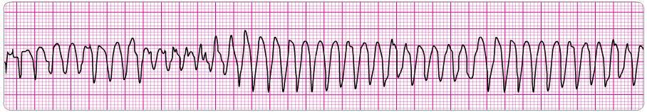 4. 5. 6. Which of the following statements about the use of magnesium in cardiac arrest is most accurate? a) Magnesium is indicated for shock-refractory monomorphic VT.