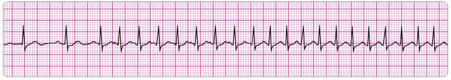 11. A 45-year-old woman with a history of palpitations develops light-headedness and palpitations. She has received adenosine 6 mg IV for the rhythm shown above without conversion of the rhythm.