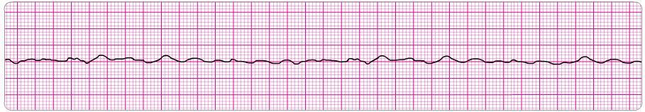 c) Sedate and perform synchronized cardioversion. d) Repeat adenosine 12 mg IV. e) Perform vagal maneuvers and repeat adenosine 6 mg IV. 12. Following initiation of CPR and 1 shock for VF, this rhythm is present on the next rhythm check.