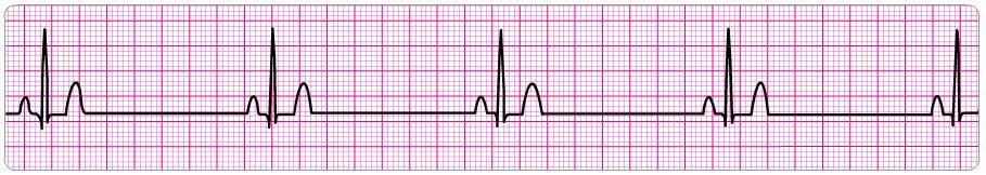 13. You arrive on the scene to find a 56-year-old diabetic woman with dizziness. She is pale and diaphoretic. Her blood pressure is 80/60 mm Hg. The cardiac monitor documents the rhythm below.
