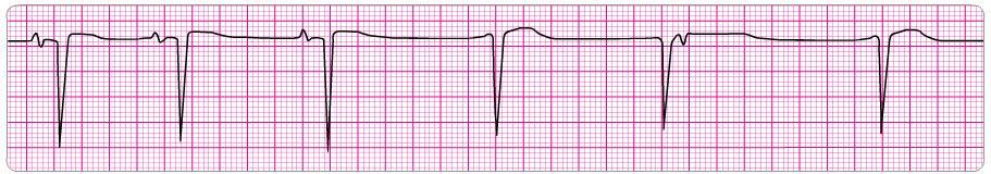 c) Morphine sulphate 4 mg IV. d) Atropine 0.5 mg IV. e) Atropine 1 mg IV. 14. A patient becomes unresponsive. You are uncertain if a faint pulse is present with the rhythm below.