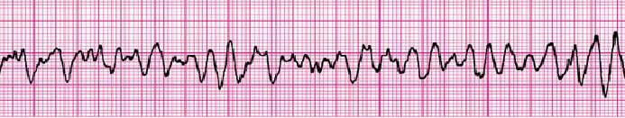 21. You are called to help resuscitate an infant with severe symptomatic bradycardia associated with respiratory distress.