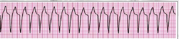 25. Identify the following rhythm: (clinical clue: heart rate 150/min) a) SVT converting to sinus rhythm with adenosine administration b) Wide-complex tachycardia (in a child with known aberrant
