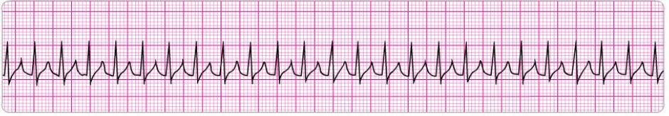 5. 6. A patient with ST-segment elevation MI has ongoing chest discomfort. Fibrinolytic therapy has been ordered.