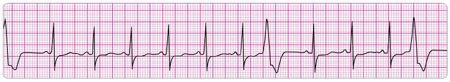11. A patient in the emergency department develops recurrent chest discomfort (8/10) suspicious for ischemia. His monitored rhythm becomes irregular as seen above.