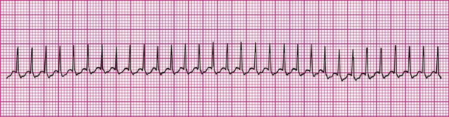 a) Begin high-quality chest compressions with ventilations b) Order transcutaneous pacing c) Start an IV and give atropine 0.01 mg/kg IV d) Start an IV and give adrenaline 0.01 mg/kg IV (0.
