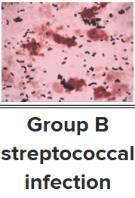 Neonatal Sepsis Group B strep
