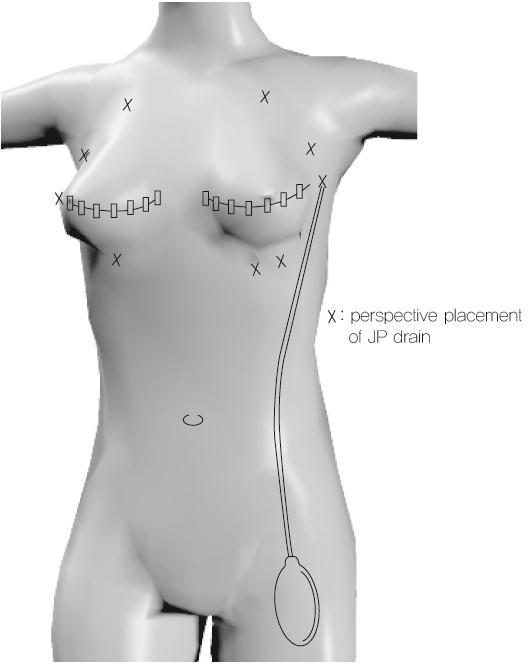 Front Perspective View of a Postmastectomy Patient s Body