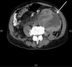 Inappropriate Fluid in Compartment Left flank pain and hypotension developed in a 62-year-old woman during treatment with intravenous heparin (900 U