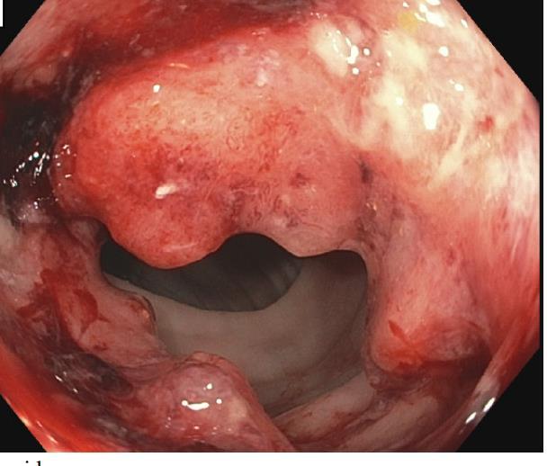 The Case for Change Large mass in sigmoid colon, biopsies consistent with moderately differentiated