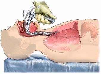 Intubation Intubation often leads to mechanical ventilator ( machine breathes for you ) Can be difficult to