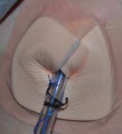 (Ward nurse to complete) One suture is used to hold the drain in place.