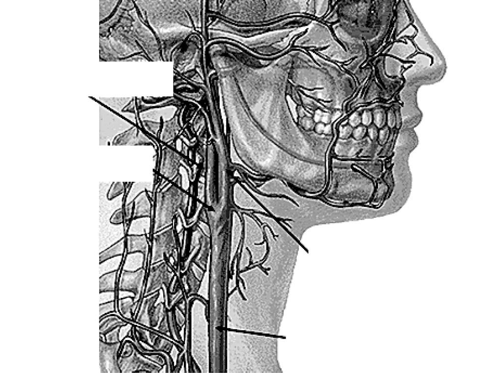 Your Condition and Your Surgery The Carotid artery is the main artery that supplies blood to the brain.