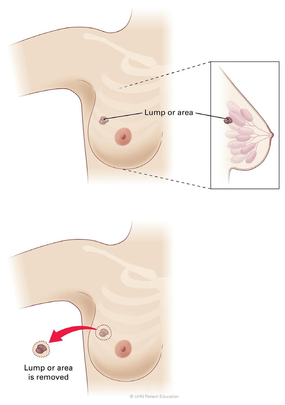 What is a lumpectomy? A lumpectomy is surgery to remove a lump in the breast, and some breast tissue around it. The amount of breast tissue removed depends on the size of the lump.