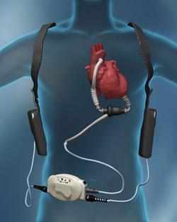 Appendix 4. Attaching a VAD to a mains power supply (Heartmate II ) The VAD is implanted in the patient.