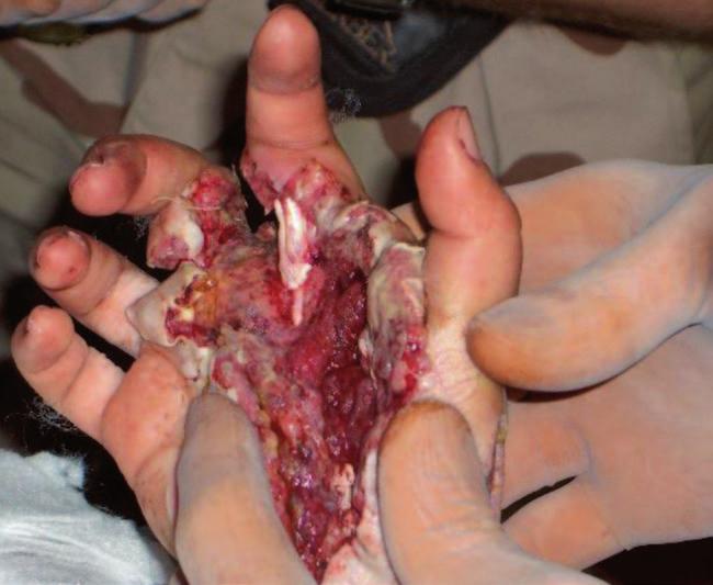 2 Traumatic Combat Injuries 19 Fig. 2.5 High-velocity gunshot wound to the hand sustained by a soldier in Iraq DoDTR [8].