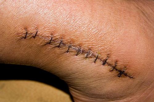 Post-Operative Information Incision Closed with staples or skin glue.