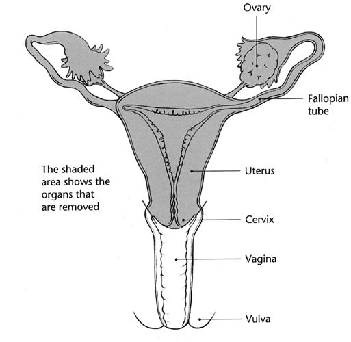 Total / Sub-total Hysterectomy With removal of ovaries All diagrams