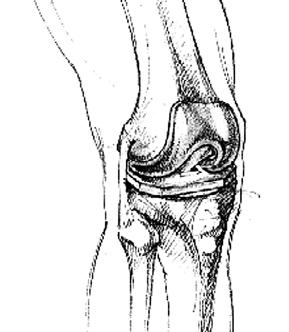 Your Operation Your knee has become diseased or injured. Simple movements may be painful, such as standing or walking.