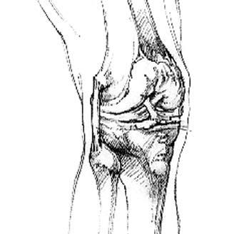 The bottom of the thigh bone (femur) rests on the top of the lower leg bones (tibia and fibula). Articular cartilage covers the ends of the knee bones.