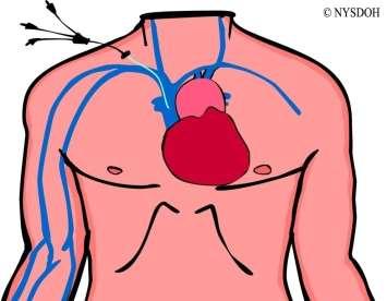 Non-tunneled CVC: short term use Inserted at the patient bedside for short term access Subclavian vein preferred to minimize the