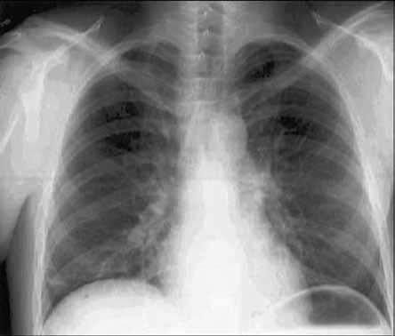 Figure 1 Chest radiograph demonstrating a right middle lobe infiltrate in patient 1.